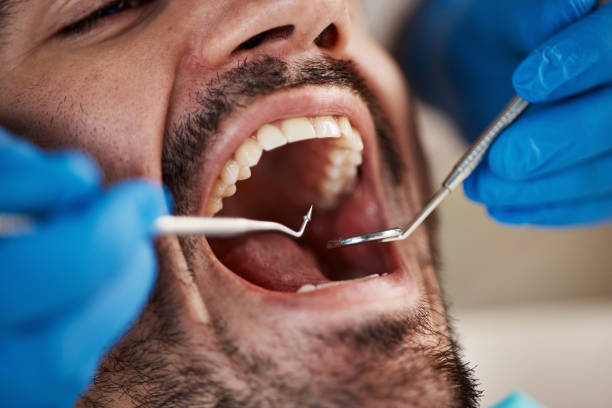 Best Emergency Dental Care for Abscessed Tooth in Warren Park, IN